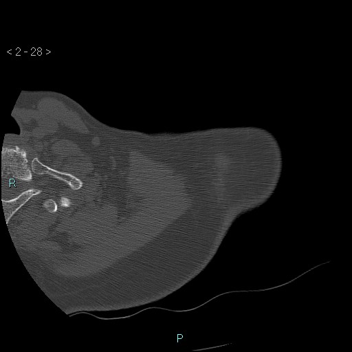 Avascular necrosis of the shoulder - Cruess stage I (Radiopaedia 77674-89887 Axial bone window 7).jpg
