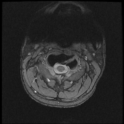 File:Axis fracture - MRI (Radiopaedia 71925-82375 Axial T2 fat sat 2).jpg