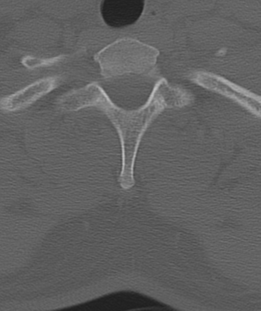 Axis peg fracture (type 3) and atlas lateral mass (type 4) fracture (Radiopaedia 37474-39324 Axial bone window 50).png