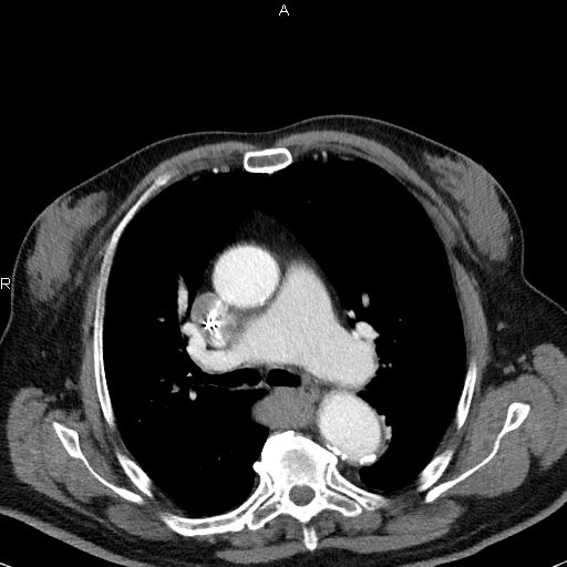 File:Azygos continuation of the inferior vena cava (Radiopaedia 18537-18404 C+ arterial phase 24).jpg