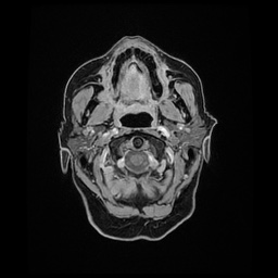 Balo concentric sclerosis (Radiopaedia 53875-59982 Axial LAVA C+ 15).jpg