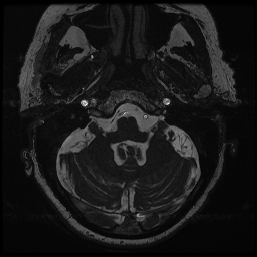 File:Balo concentric sclerosis (Radiopaedia 53875-59982 Axial T2 FIESTA 18).jpg