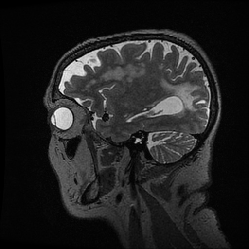 Balo concentric sclerosis (Radiopaedia 53875-59982 Sagittal 3D FSE 73).jpg