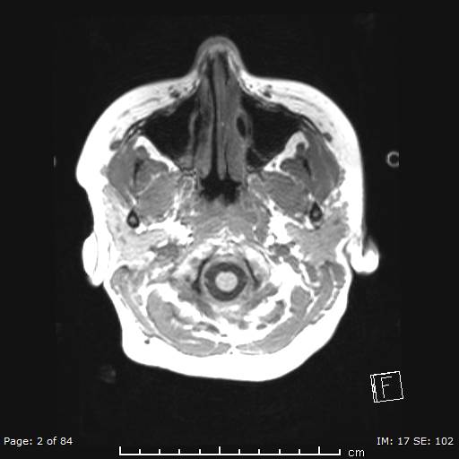 File:Balo concentric sclerosis (Radiopaedia 61637-69636 Axial T1 2).jpg
