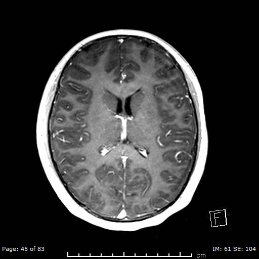 Balo concentric sclerosis (Radiopaedia 61637-69636 Axial T1 C+ 45).jpg