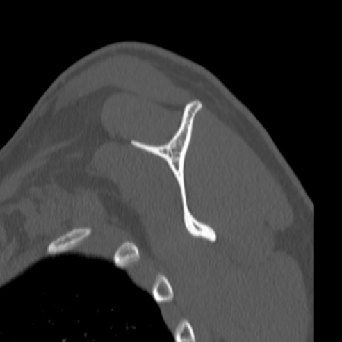 Bankart lesion (Radiopaedia 57256-64185 Sagittal bone window 43).jpg