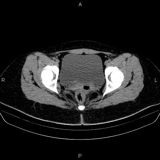 Bartholin gland cyst (Radiopaedia 62635-70930 Axial non-contrast 63).jpg
