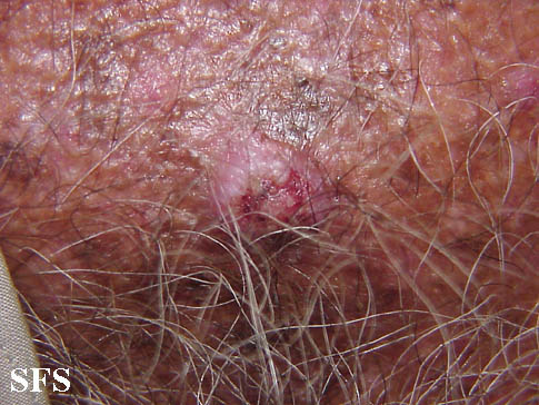 Basal Cell Carcinoma (Dermatology Atlas 48).jpg