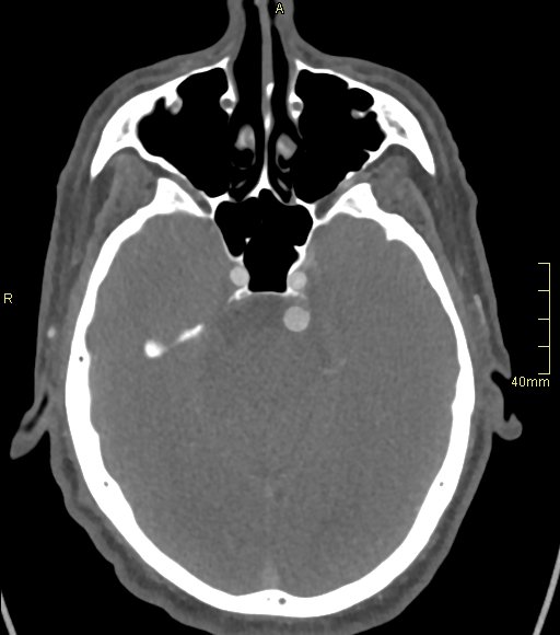 Basilar artery aneurysm (Radiopaedia 56261-62932 A 62).jpg