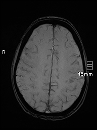 Basilar artery perforator aneurysm (Radiopaedia 82455-99523 Axial SWI 47).jpg