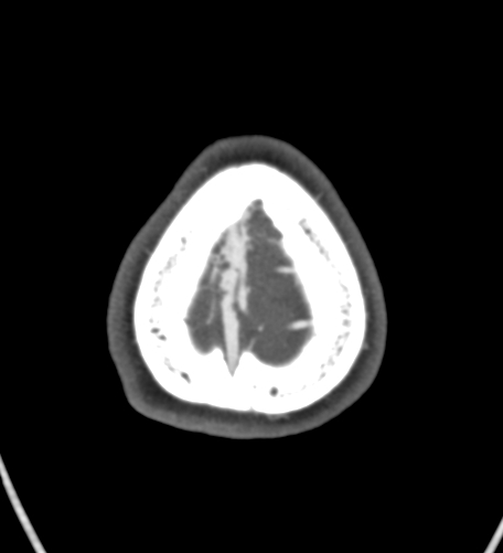 File:Basilar tip aneurysm with coiling (Radiopaedia 53912-60086 A 143).jpg