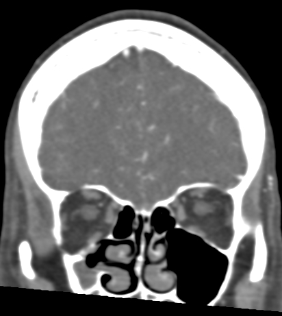 Basilar tip aneurysm with coiling (Radiopaedia 53912-60086 B 28).jpg
