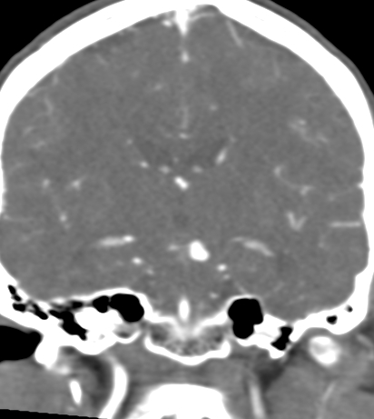 Basilar tip aneurysm with coiling (Radiopaedia 53912-60086 B 79).jpg