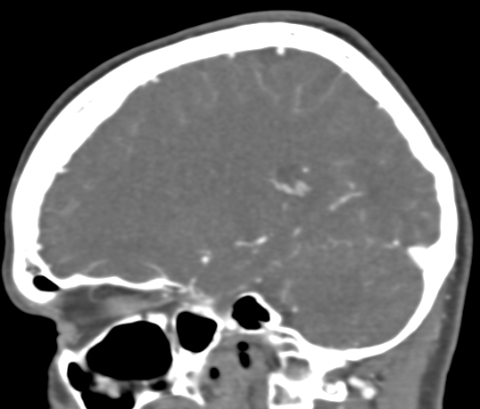 Basilar tip aneurysm with coiling (Radiopaedia 53912-60086 C 46).jpg