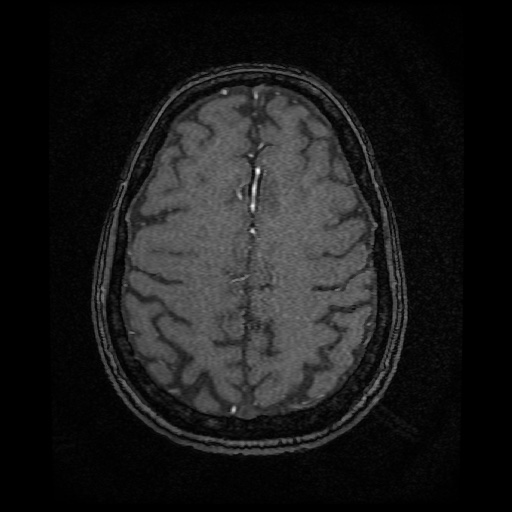 Basilar top and left middle cerebral artery aneurysm (Radiopaedia 61965-70031 Axial MRA 131).jpg