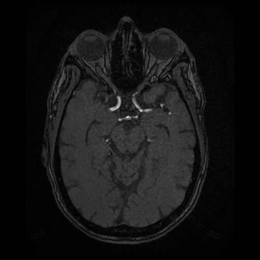Basilar top and left middle cerebral artery aneurysm (Radiopaedia 61965-70031 Axial MRA 61).jpg