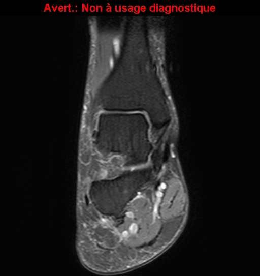 File:Baxter neuropathy (Radiopaedia 25988-26124 Coronal T2 fat sat 2).jpg