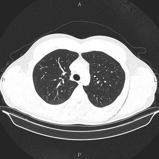Beam hardening and ring artifacts (Radiopaedia 85323-100915 Axial lung window 26).jpg