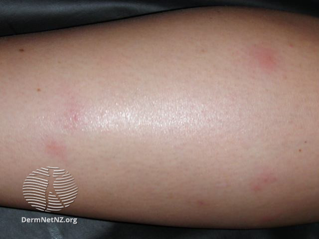 File:Bed bug bites (DermNet NZ arthropods-bedbug-bite1).jpg