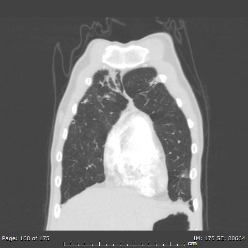 Behçet disease (Radiopaedia 44247-47889 Coronal lung window 54).jpg