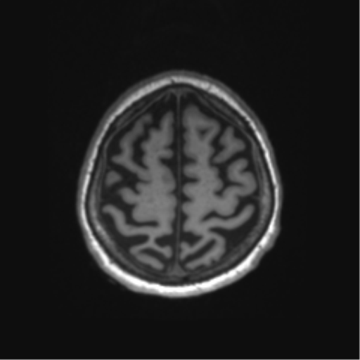 Behavioral variant frontotemporal dementia and late onset schizophrenia (Radiopaedia 52197-58083 Axial T1 8).png