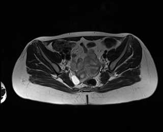 File:Bicornuate bicollis uterus (Radiopaedia 61626-69616 Axial T2 15).jpg
