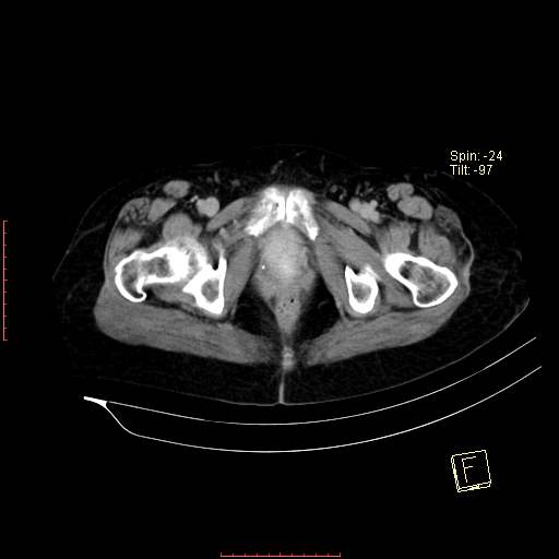 File:Bifid ureter (Radiopaedia 47604-52253 Axial C+ delayed 31).jpg
