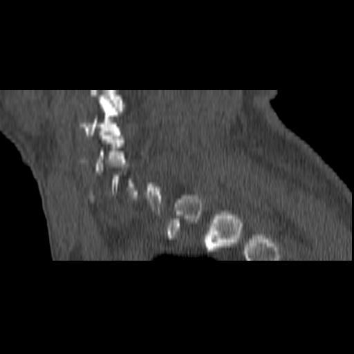 File:Bilateral C6-7 locked facet dislocation (Radiopaedia 28506-28748 Sagittal bone window 1).jpeg