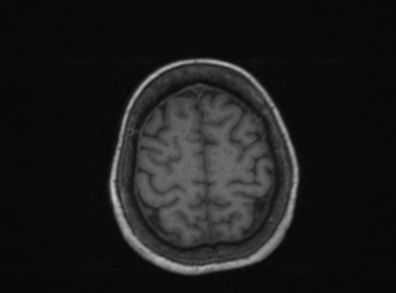File:Bilateral PCA territory infarction - different ages (Radiopaedia 46200-51784 Axial T1 152).jpg