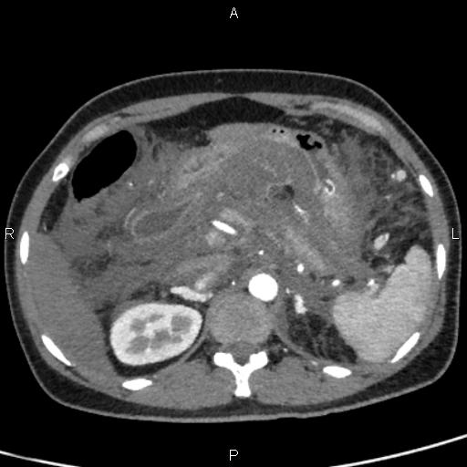 Bilateral adrenal gland hyperenhancement in pancreatitis (Radiopaedia 86642-102753 B 38).jpg