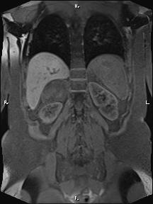 File:Bilateral adrenal myelolipoma (Radiopaedia 63058-71537 Coronal T1 fat sat 30).jpg