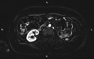 Bilateral adrenal myelolipoma (Radiopaedia 63058-71537 I 57).jpg