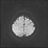 File:Bilateral basal ganglia and thalamic T1 hyperintensities (Radiopaedia 19764-19802 Axial DWI 36).jpg