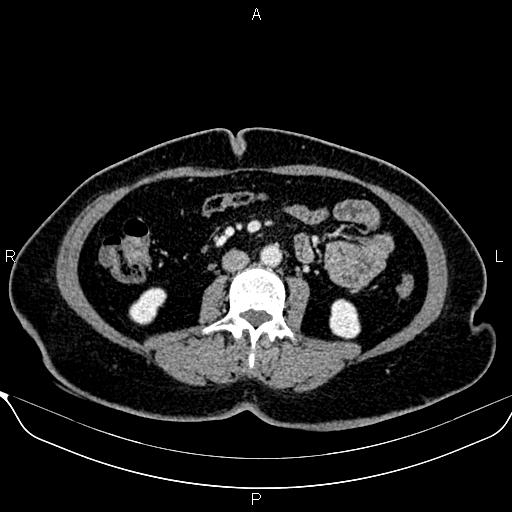 Bilateral benign adrenal adenomas (Radiopaedia 86912-103124 B 58).jpg