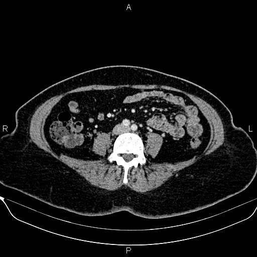 Bilateral benign adrenal adenomas (Radiopaedia 86912-103124 B 67).jpg