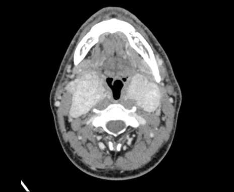 Bilateral carotid body tumors (Radiopaedia 61841-69870 Axial Post contrast 44).jpg