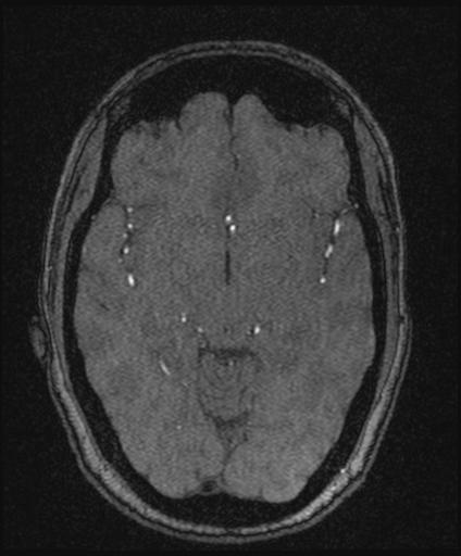 Bilateral carotid body tumors and right glomus jugulare tumor (Radiopaedia 20024-20060 Axial MRA 83).jpg