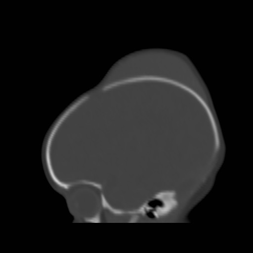 File:Bilateral cephalohematomas and subdural hematomas (Radiopaedia 26778-26929 Sagittal bone window 10).jpg
