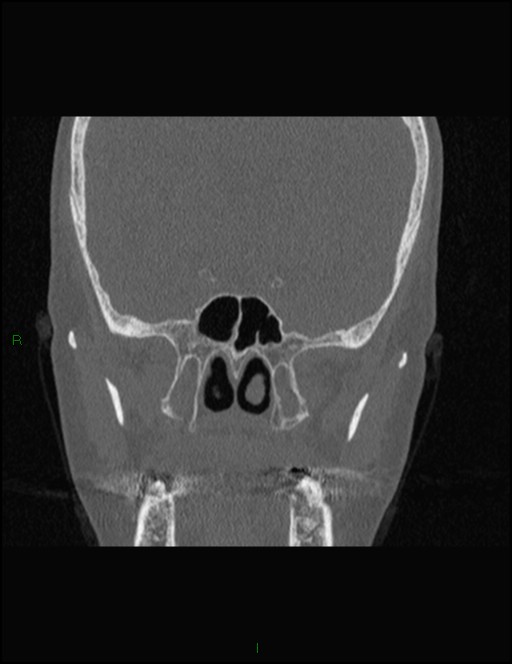 Bilateral frontal mucoceles (Radiopaedia 82352-96454 Coronal 219).jpg