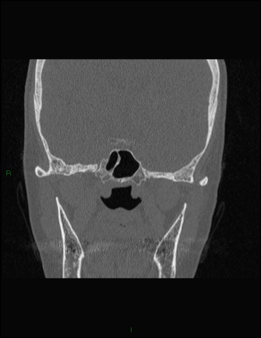 Bilateral frontal mucoceles (Radiopaedia 82352-96454 Coronal 240).jpg