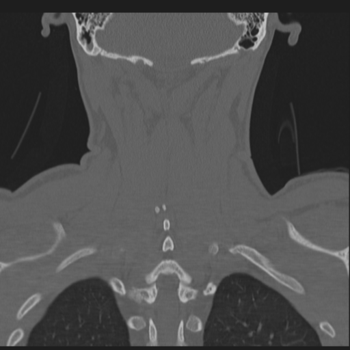 File:Bilateral locked facets (Radiopaedia 33850-35016 Coronal bone window 68).png
