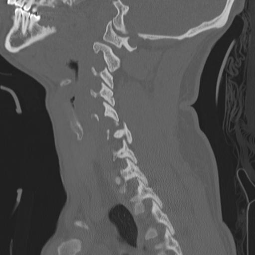Bilateral locked facets (Radiopaedia 33850-35016 Sagittal bone window 33).png