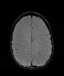 Bilateral mesial temporal polymicrogyria (Radiopaedia 76456-88181 Axial SWI 52).jpg