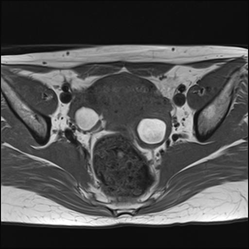 File:Bilateral ovarian endometriomas (Radiopaedia 87085-103347 Axial T1 10).jpg