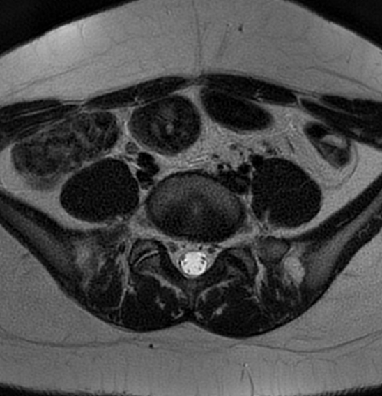 File:Bilateral ovarian fibrothecomas - adolescent (Radiopaedia 86604-102707 Axial T2 3).jpg
