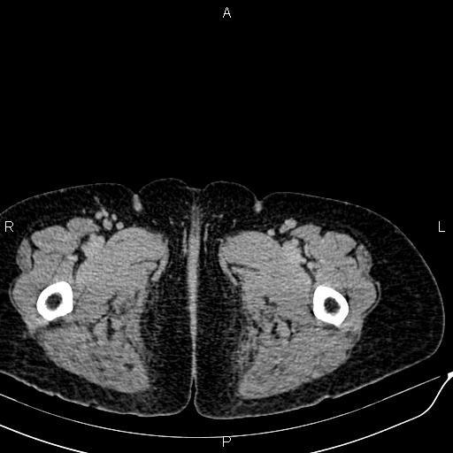 Bilateral ovarian serous cystadenocarcinoma (Radiopaedia 86062-101989 Axial C+ delayed 94).jpg