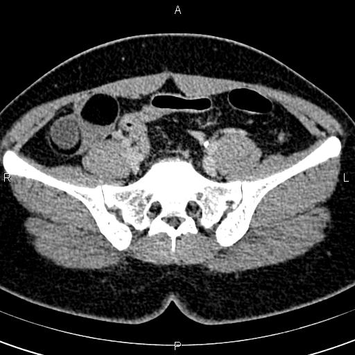 Bilateral ovarian teratoma (Radiopaedia 83131-97503 B 22).jpg