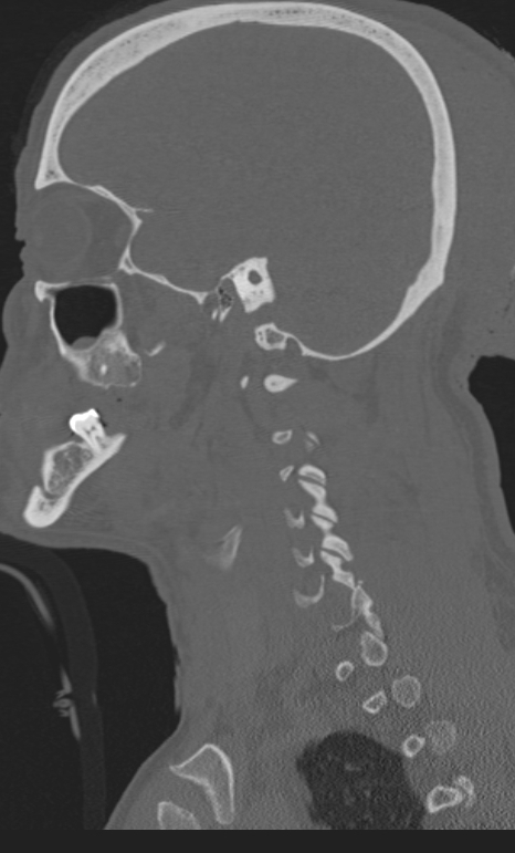 Bilateral perched facet joint (Radiopaedia 63149-71669 Sagittal bone window 63).jpg