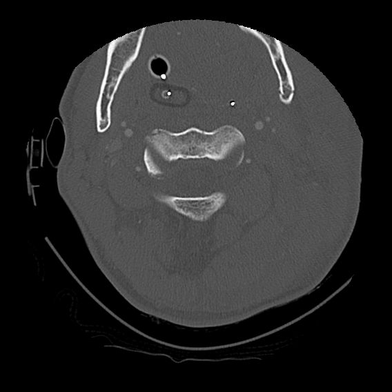 Bilateral perched facets with cord injury (Radiopaedia 45587-49713 Axial bone window 33).jpg