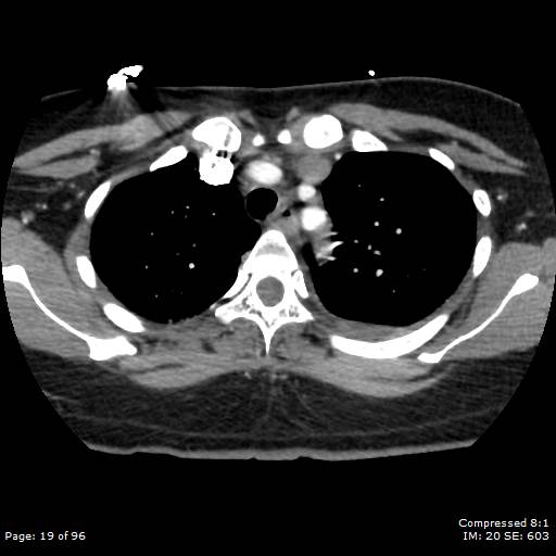 Bilateral pulmonary emboli with Hampton hump sign (Radiopaedia 54070-60246 Axial C+ CTPA 16).jpg